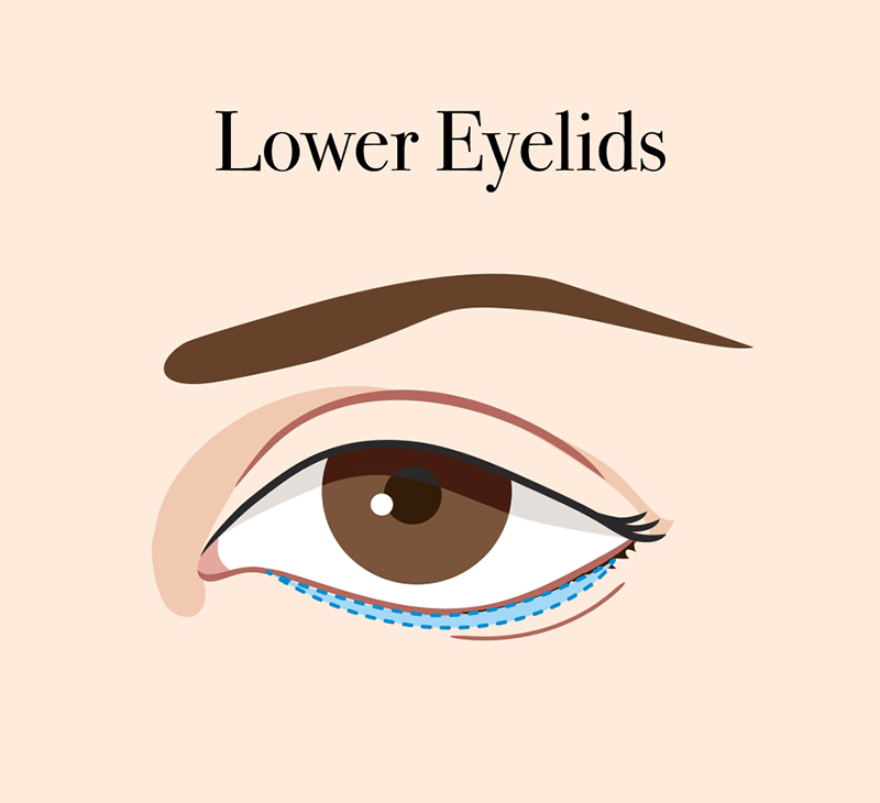 Lower Eyelid Blepharoplasty