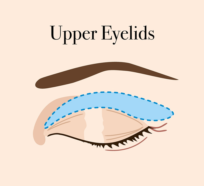 Upper Eyelid Blepharoplasty