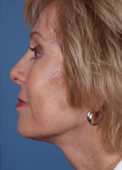 Blepharoplasty Before & After Photo