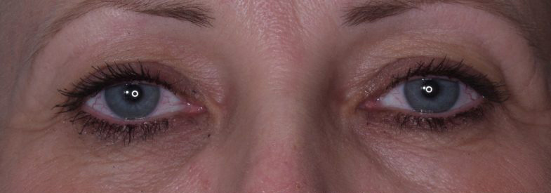 Blepharoplasty Before & After Photo