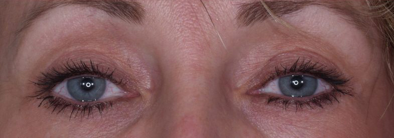 Blepharoplasty Before & After Photo