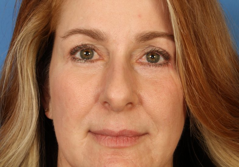 Blepharoplasty Before & After Photo