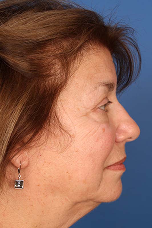 Facelift Before & After Photo