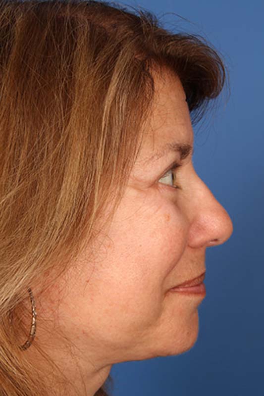 Facelift Before & After Photo