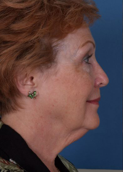 Facelift Before & After Photo