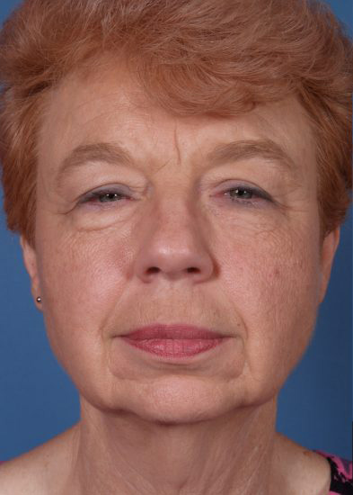 Facelift Before & After Photo