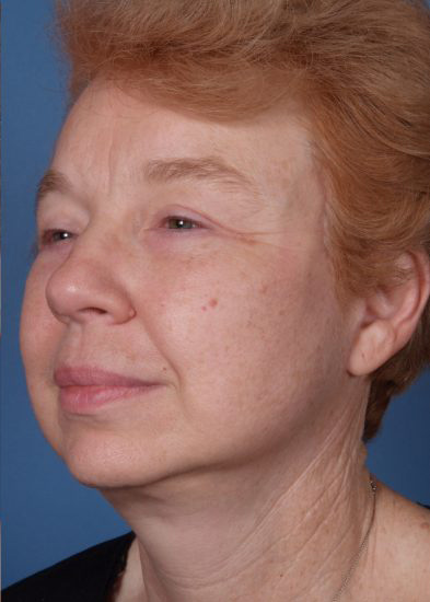 Facelift Before & After Photo