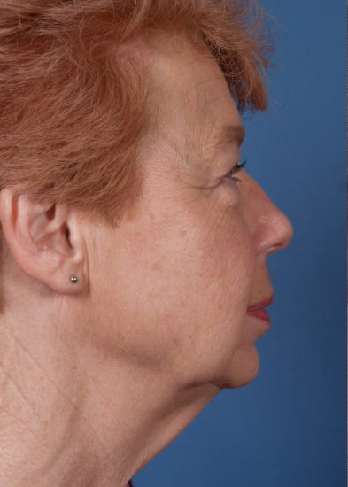 Facelift Before & After Photo