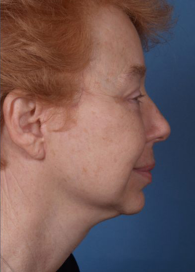 Facelift Before & After Photo