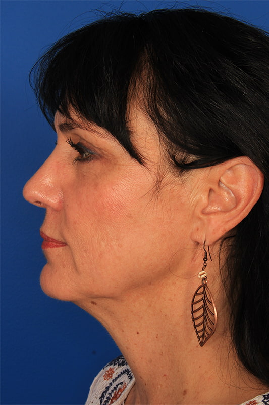 Neck Lift Before & After Photo