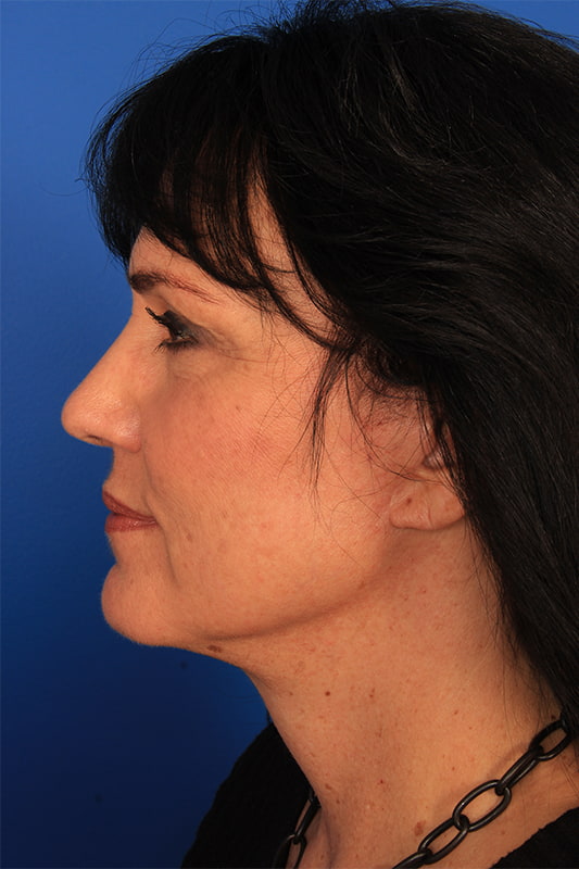 Neck Lift Before & After Photo