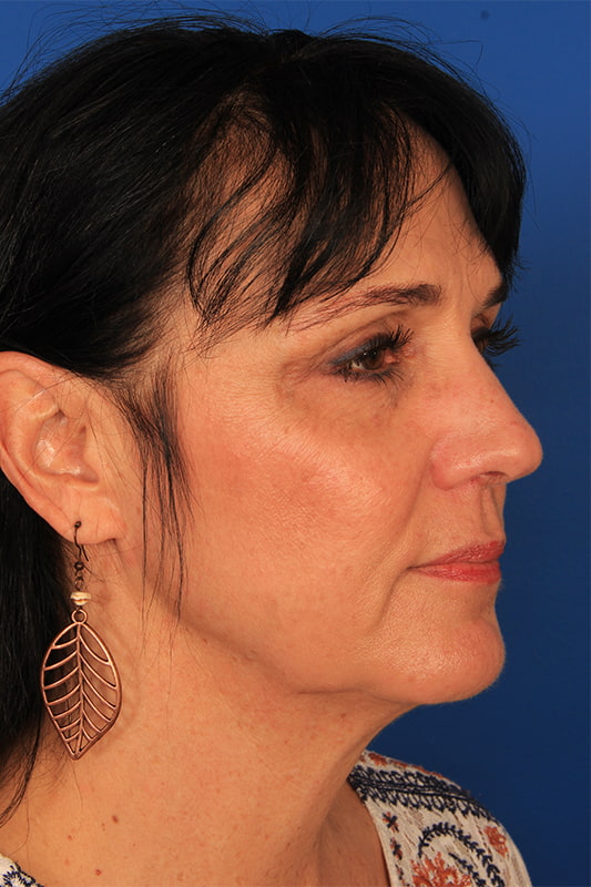 Neck Lift Before & After Photo