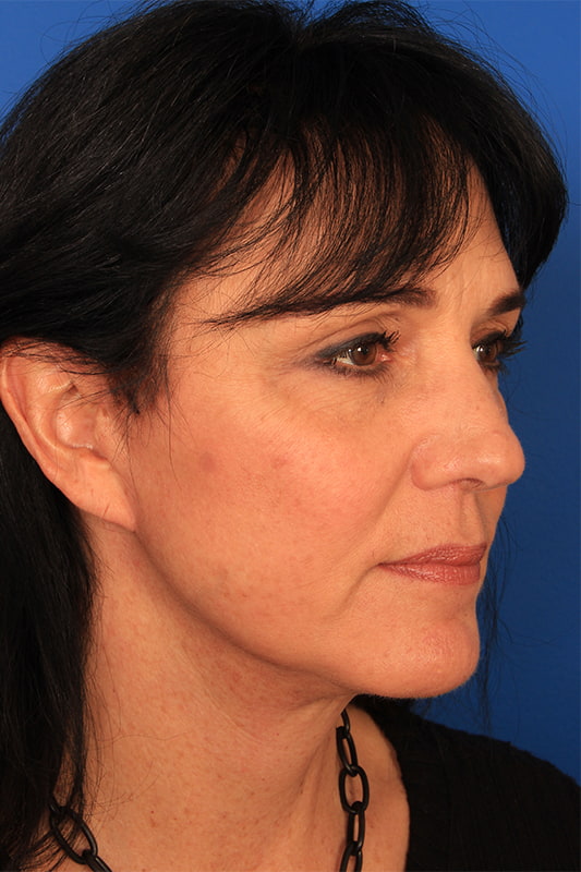 Neck Lift Before & After Photo