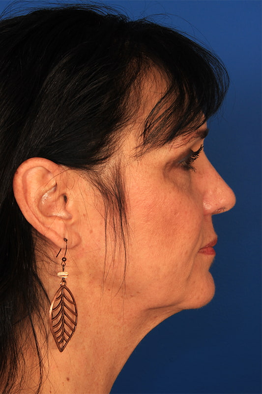 Neck Lift Before & After Photo