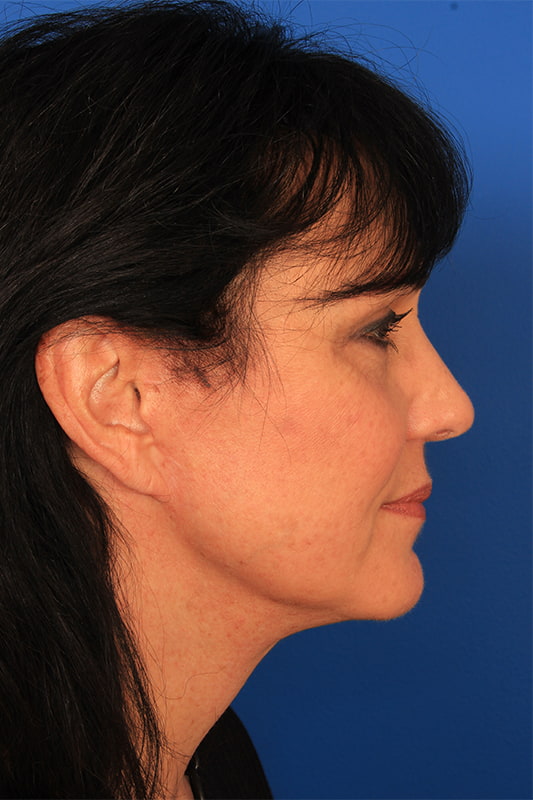 Neck Lift Before & After Photo