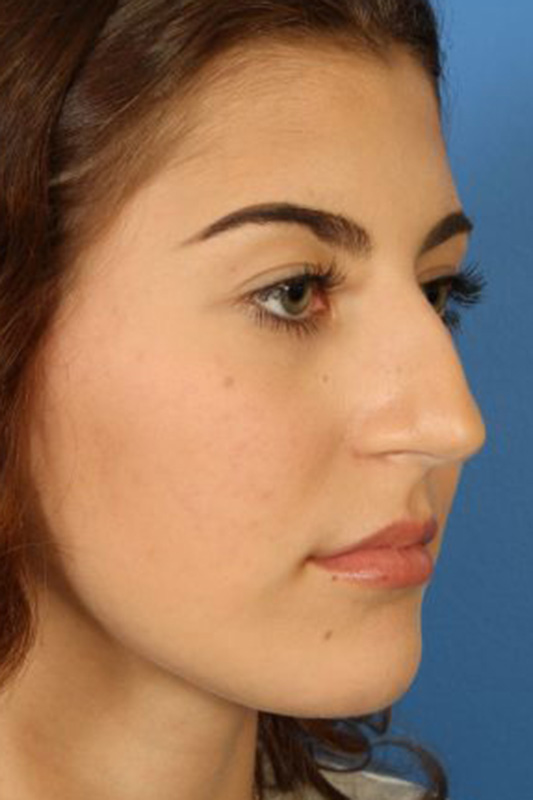 Rhinoplasty Before & After Photo