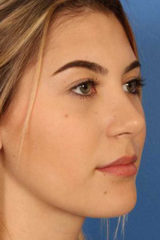 Rhinoplasty Before & After Photo