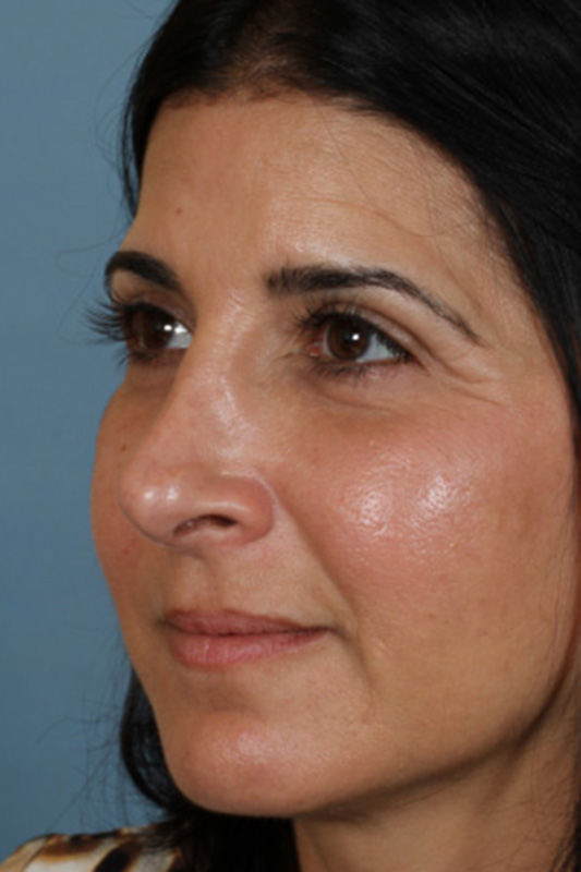 Rhinoplasty Before & After Photo