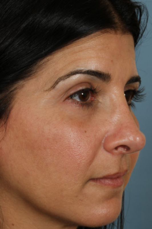 Rhinoplasty Before & After Photo