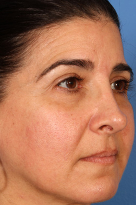 Rhinoplasty Before & After Photo