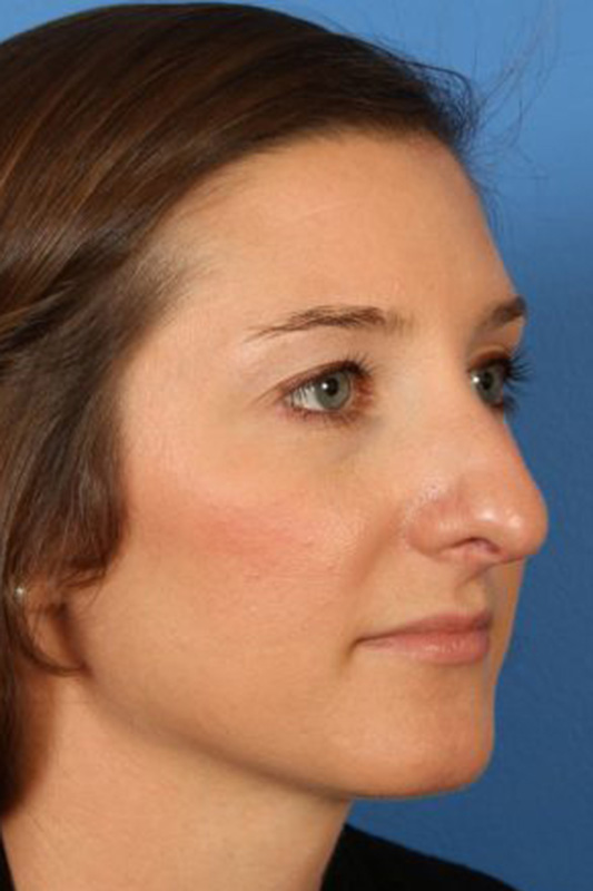 Rhinoplasty Before & After Photo