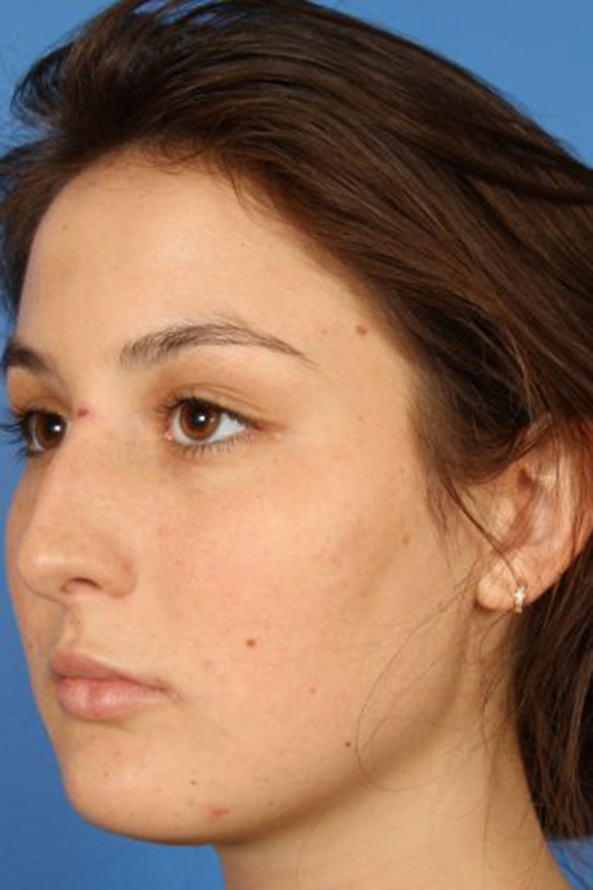 Rhinoplasty Before & After Photo