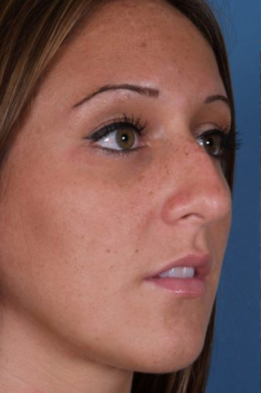 Rhinoplasty Before & After Photo