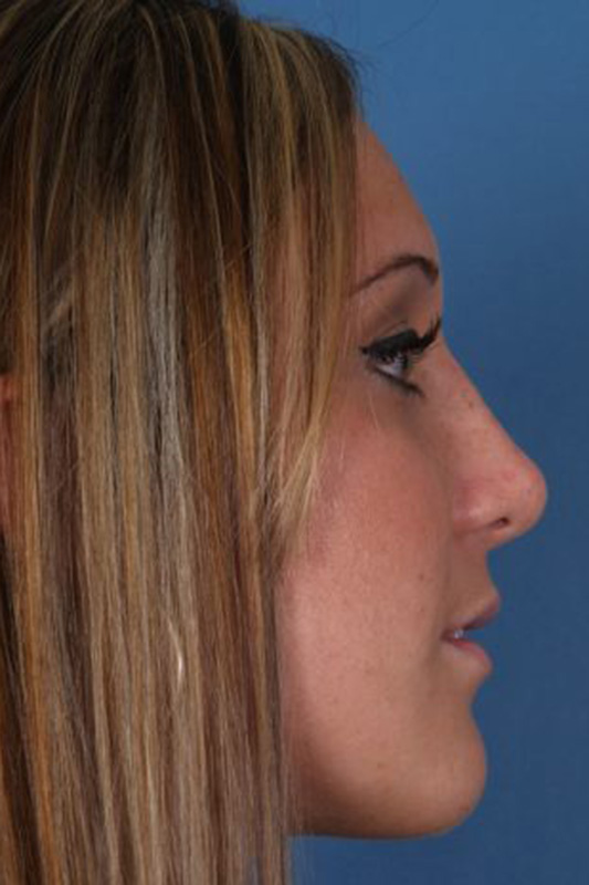 Rhinoplasty Before & After Photo