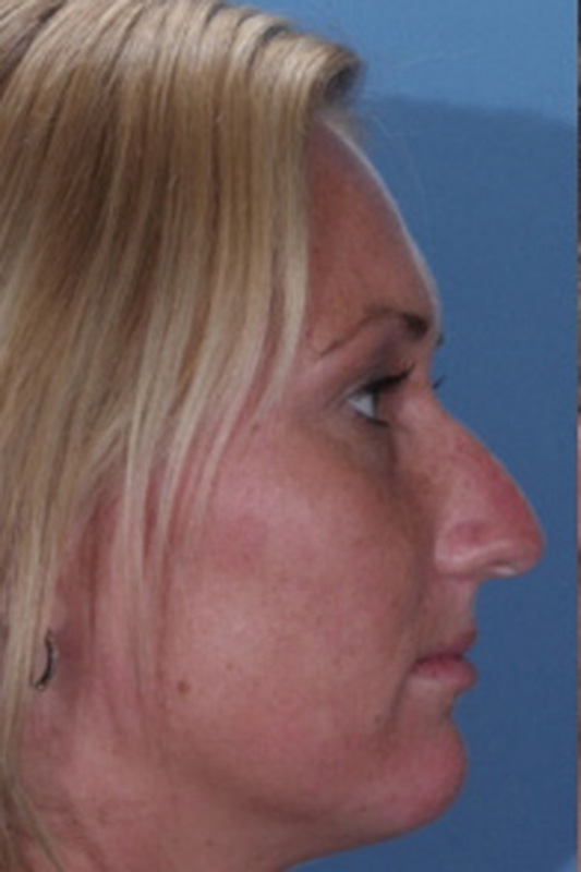 Rhinoplasty Before & After Photo