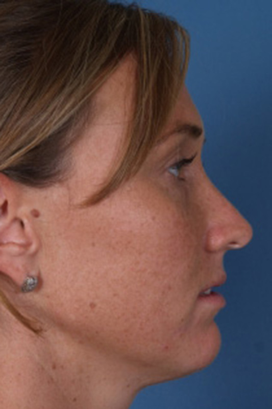 Rhinoplasty Before & After Photo